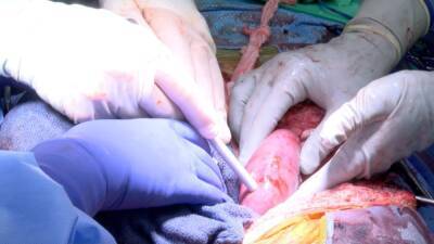 Primer trasplante de dos riñones de un cerdo a un humano - en.as.com - state Alabama