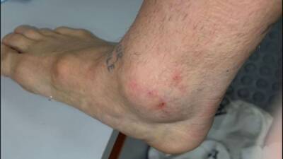 Angel Di-Maria - 'Papu' Gómez muestra su tobillo en redes tras la batalla en Calama - AS Argentina - en.as.com - Argentina - Chile