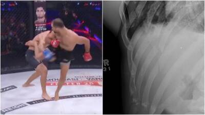 Bellator fighter Chance Recountre’s x-ray after spinning kick breaks five ribs - givemesport.com