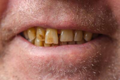 Manchas en los dientes: ¿por qué aparecen y cómo eliminarlas? - Mejor con Salud