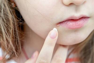 ¿Cómo diferenciar entre un grano y herpes labial? - Mejor con Salud