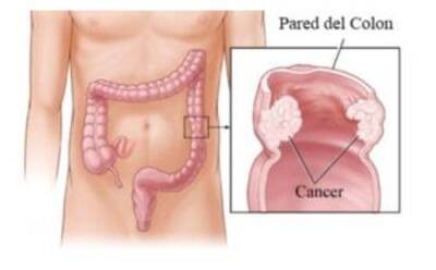 5 consejos para intentar prevenir el cáncer de colon - Mejor con Salud