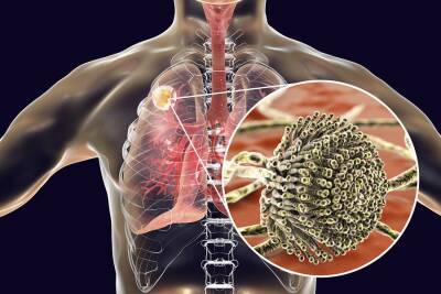 Aspergilosis y hongos en los pulmones - Mejor con Salud