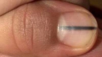 ¿Una línea negra en tus uñas podría ser una señal de cáncer? - Mejor con Salud