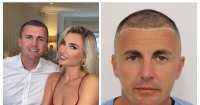 Billie Faiers' husband Greg Shepherd praised for speaking out over hair transplant after he realising he was 'going bald'