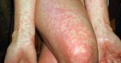 Parents urged to watch out for highly contagious scarlet fever amid confirmed cases in Wigan