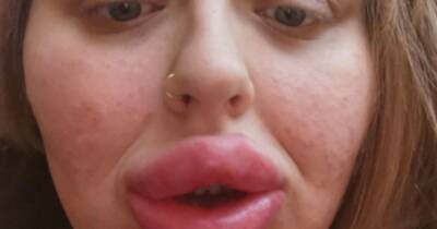 Woman hospitalised after 'baboon bum' lip fillers 'got bigger and bigger'