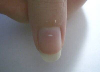 ¿Qué significan las manchas blancas en las uñas? - Mejor con Salud
