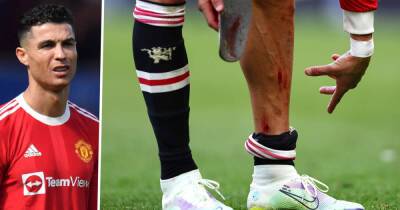 Ronaldo shows off nasty gash & blood-stained shin pad as he limps away after Man Utd's defeat to Everton