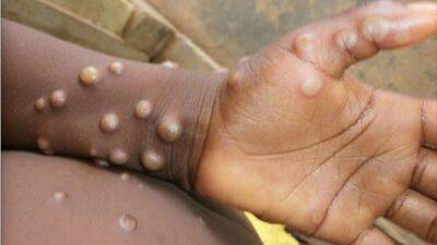 Monkeypox: What we know about the smallpox-like virus spreading in the UK, Portugal and Spain