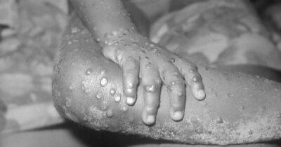 Monkeypox cases in UK more than double to 20 - manchestereveningnews.co.uk - Britain - Spain - Portugal - Usa - Nigeria