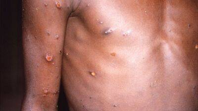 Viruela del mono, última hora en directo | Casos de la Monkeypox en España | Síntomas, contagios...