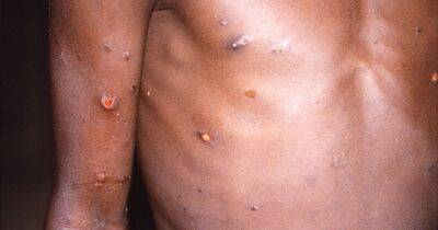 How do you catch monkeypox? What we know about virus transmission as cases rise