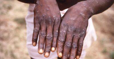'Concerned' medics have a plan to deal with monkeypox if it spreads to Greater Manchester