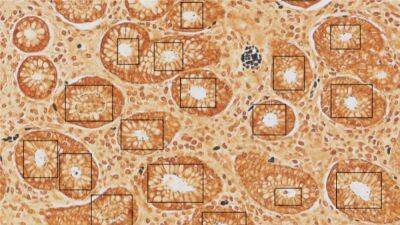 Crean la primera vacuna contra el virus de la esclerosis múltiple y la mononucleosis - en.as.com