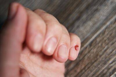 ¿Cómo reconocer los tumores en las uñas? - Mejor con Salud