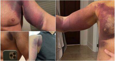 Seth Rollins - Cody Rhodes - Cody Rhodes injury: Gruesome photos of his torn pec progression - givemesport.com