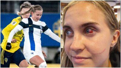 Female footballer shows gruesome eye injury from opponent's fake nails