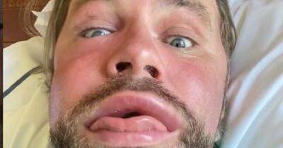 Brian McFadden says 'face is calming down' after alarming fans with bee sting video - manchestereveningnews.co.uk