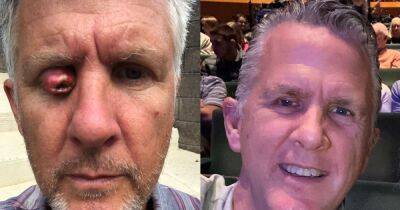 Dad at risk of losing sight as eyelid swelled to ‘size of cherry tomato’ after devastating diagnosis - manchestereveningnews.co.uk - Mexico