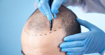 A hair transplant in Turkey is one form of treatment that can help with hair restoration