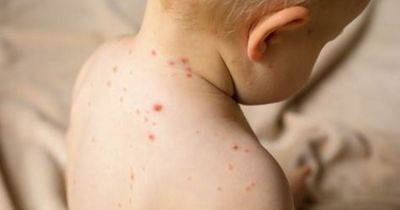 Warning issued to parents after number of measles cases in Greater Manchester - manchestereveningnews.co.uk - Britain - Manchester - London