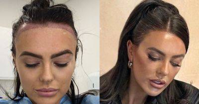 Celebrity surgeon says more women are having hair transplants to shrink foreheads thanks to Love Island star