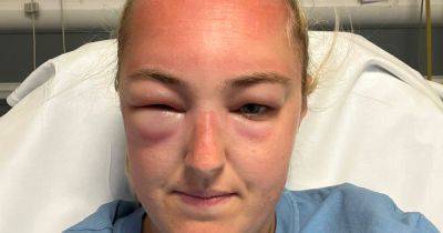 Woman discovers she is allergic to the SUN after her face blows up