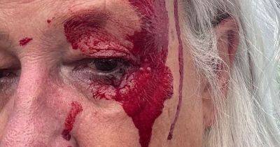 Woman's horrific, bloody ordeal as seagull launches vicious attack - manchestereveningnews.co.uk