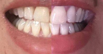 Star - Amazon's 'dentist-approved' £19 teeth whitening solution hailed 'game-changer' for anyone wanting to reverse 'years of coffee and fizzy drink stains' - manchestereveningnews.co.uk