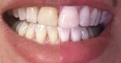 Amazon's 'dentist-approved' £19 teeth whitening solution hailed 'game-changer' for anyone wanting to erase 'a lifetime of tea and coffee stains' - manchestereveningnews.co.uk