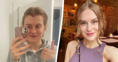 'I wanted the same hairline as my identical twin sister - so I spent over £5,000 on two transplants' - manchestereveningnews.co.uk - Britain - Turkey - Instagram