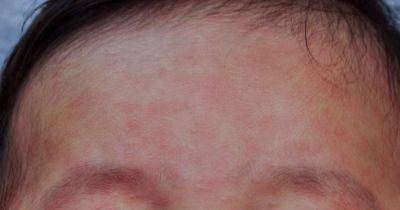 Health bosses issue urgent plea as measles cases rise in Greater Manchester town