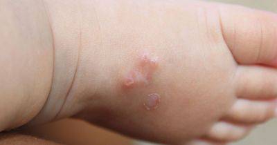 Victorian illness with worrying complications infects hundreds after outbreak in north - manchestereveningnews.co.uk - county York