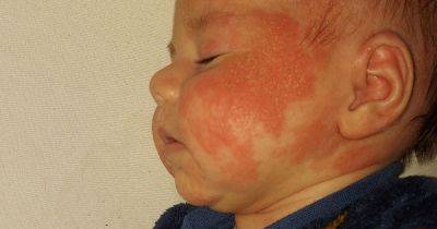 'Doctors said my son may have a milk allergy, weeks later he looked like a burns victim' - manchestereveningnews.co.uk