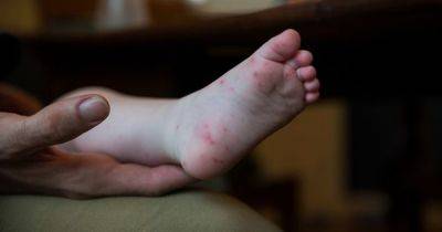 Handy chart shows parents how long kids need to be off school or nursery with rashes and illnesses - manchestereveningnews.co.uk - Britain