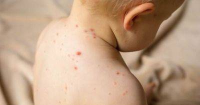 Manchester doctors reporting more suspected measles infections than almost anywhere in country - manchestereveningnews.co.uk - Britain