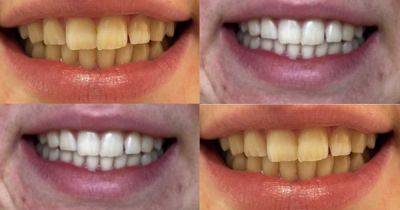 Boots shoppers 'swear by' £10 teeth whitening pen to remove years of tea, coffee and red wine stains