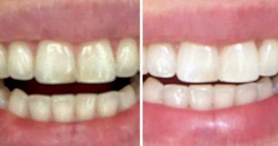 Shoppers swear they've 'got confidence back' since trying 'brilliant' £25 teeth whitening powder even dentists love