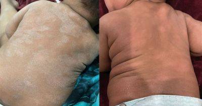 £8 'miracle in a jar' has parents 'ditching' eczema creams for natural remedy - manchestereveningnews.co.uk