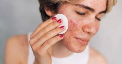 Dermatologist says knowing acne cause and type 'helps target treatment' - manchestereveningnews.co.uk