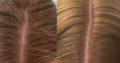 TikToker shares simple hack with a 'holy grail' holiday essential soothes sunburnt and dry scalps