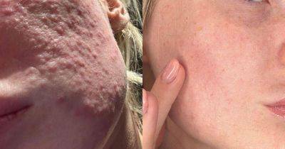 Beauty buffs floored by before and after results from 'miracle' skin serum - manchestereveningnews.co.uk