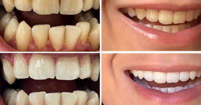 Get 30% off 'worth every penny' teeth whitener perfect for anyone with tea or coffee stains