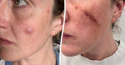 'I thought it was a spot - but it turned out to be a cyst and now I have permanent scars on my face'