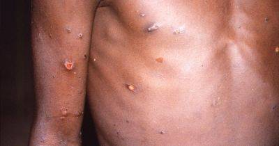 New case of mpox detected in the UK after ‘concerning’ surge in cases in Uganda