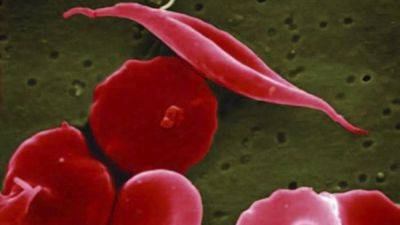 ‘Much-needed hope’ as CRISPR gene editing therapy recommended for sickle cell disease - euronews.com - Britain