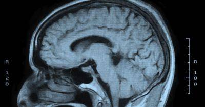 Common injury may trigger Alzheimer’s disease by awakening hidden virus, study warns - manchestereveningnews.co.uk - Britain